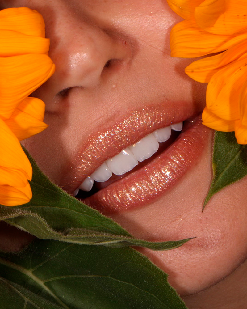 Sorriso com lentes em resina — Dra. Bárbara Guimarães